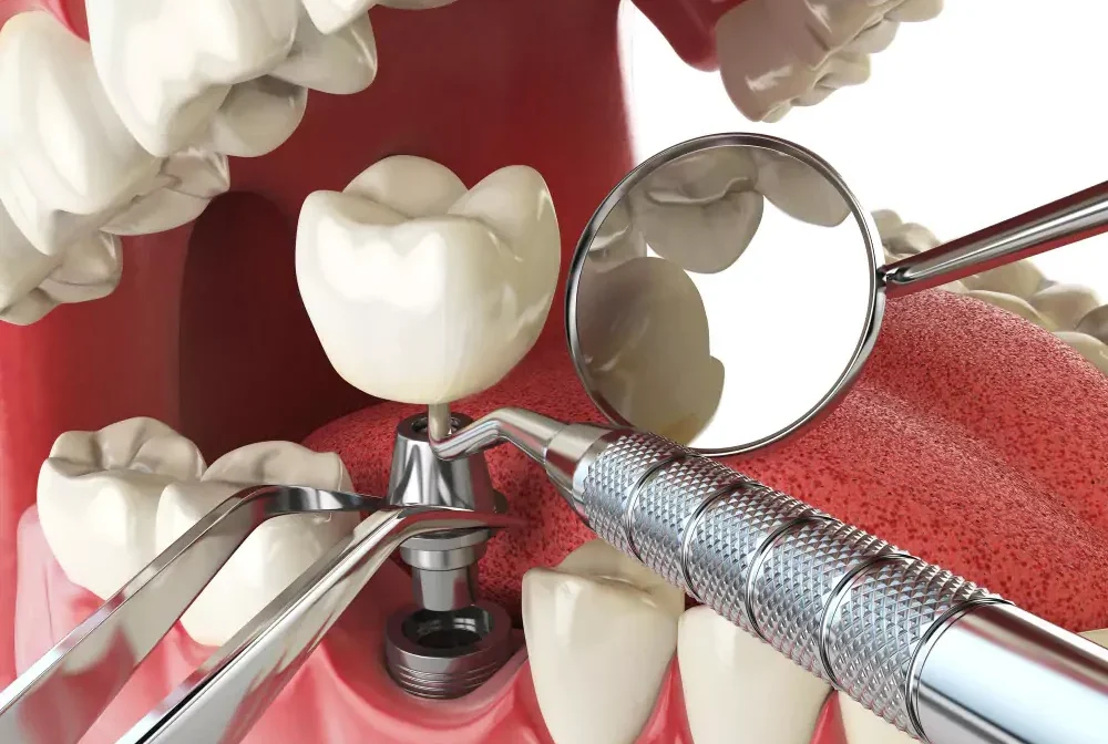 Dental Imolant