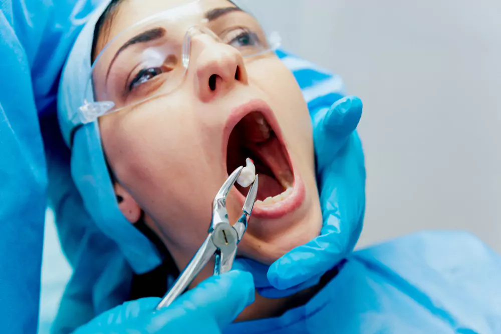 Tooth Extractions