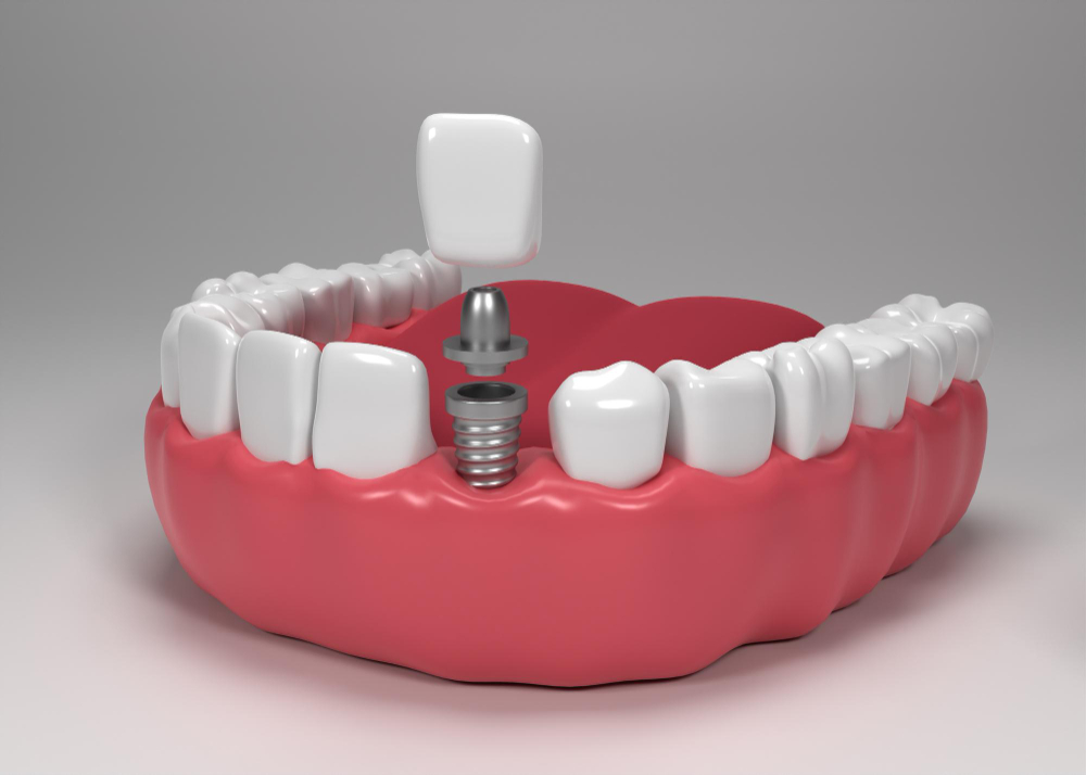 Dental Implant