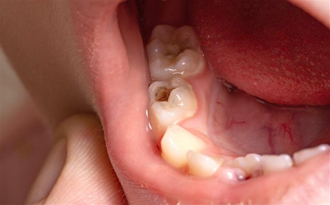 All About Tooth Decays or Dental Cavities (Dental Caries)